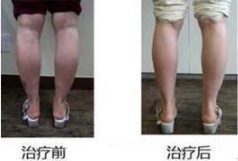 矫正内八字视频教程,跟随视频教程，重塑优美步态